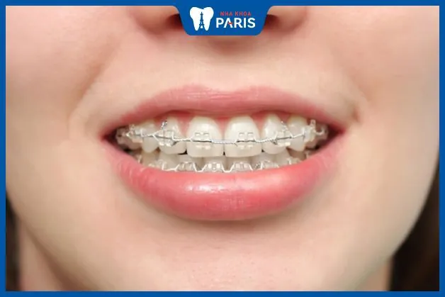 Răng hô nhẹ: Nhận biết và cách khắc phục tại nhà