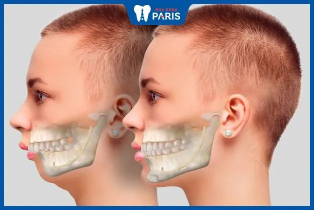 Răng vẩu: Tìm hiểu về nguyên nhân, cách điều trị cụ thể