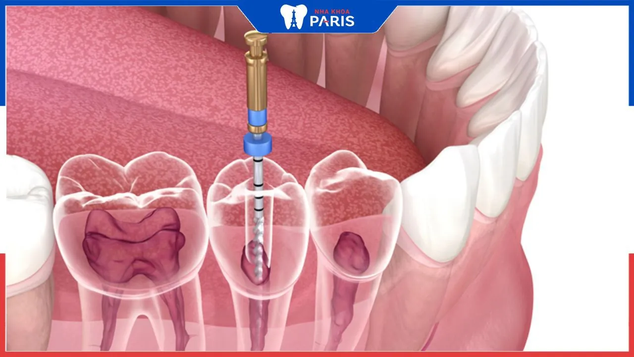 Chữa viêm tủy răng có đau không? Lưu ý quan trọng