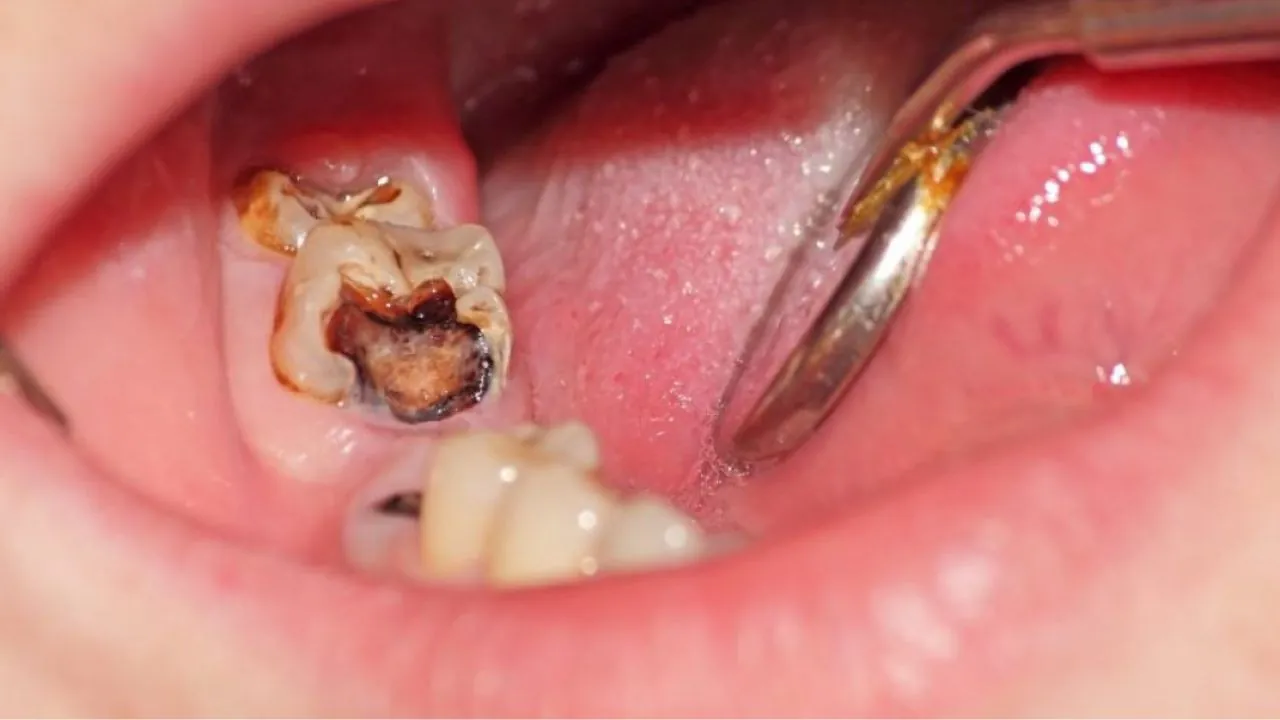 10 Cách chữa sâu răng cho người lớn hiệu quả