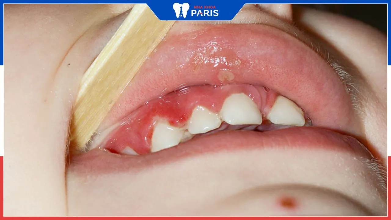 10 Cách chữa viêm lợi cho trẻ dưới 2 tuổi cha mẹ nên biết