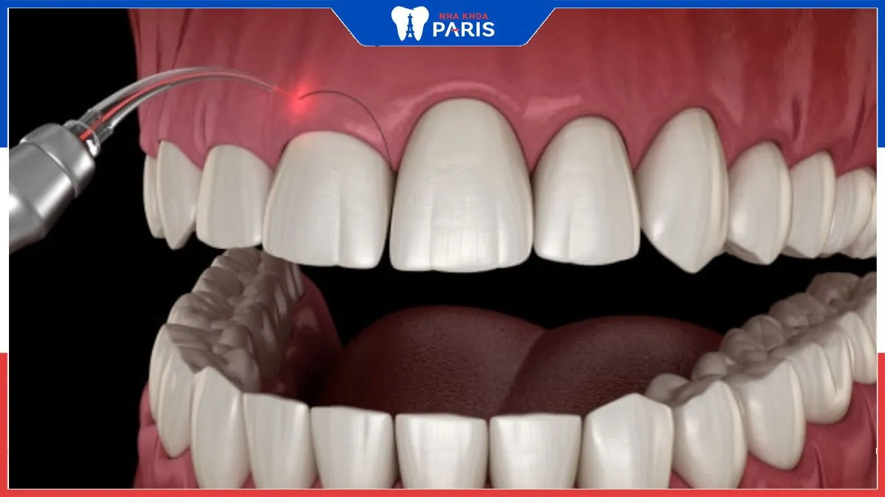 Cắt lợi có mọc lại không? Thông tin quan trọng cần biết