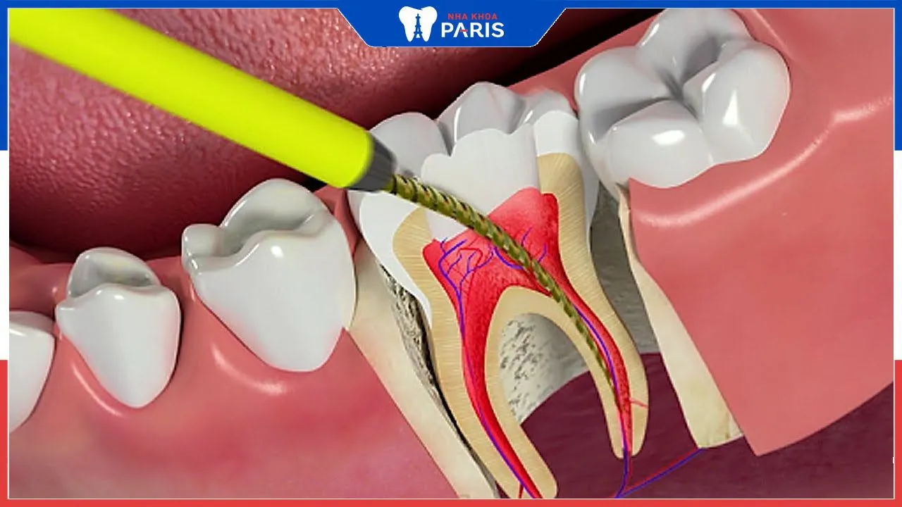 Lấy chỉ máu răng là gì? Quy trình thực hiện an toàn