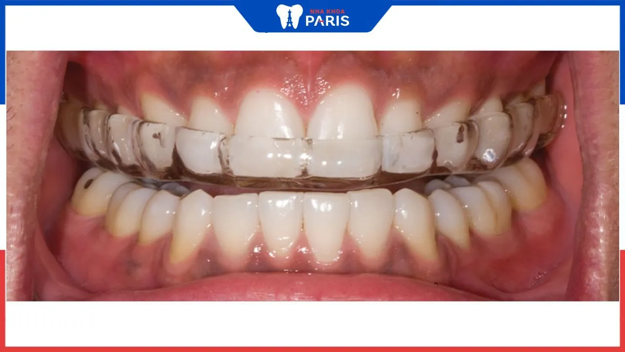 Tác dụng máng nhai điều trị khớp thái dương hàm