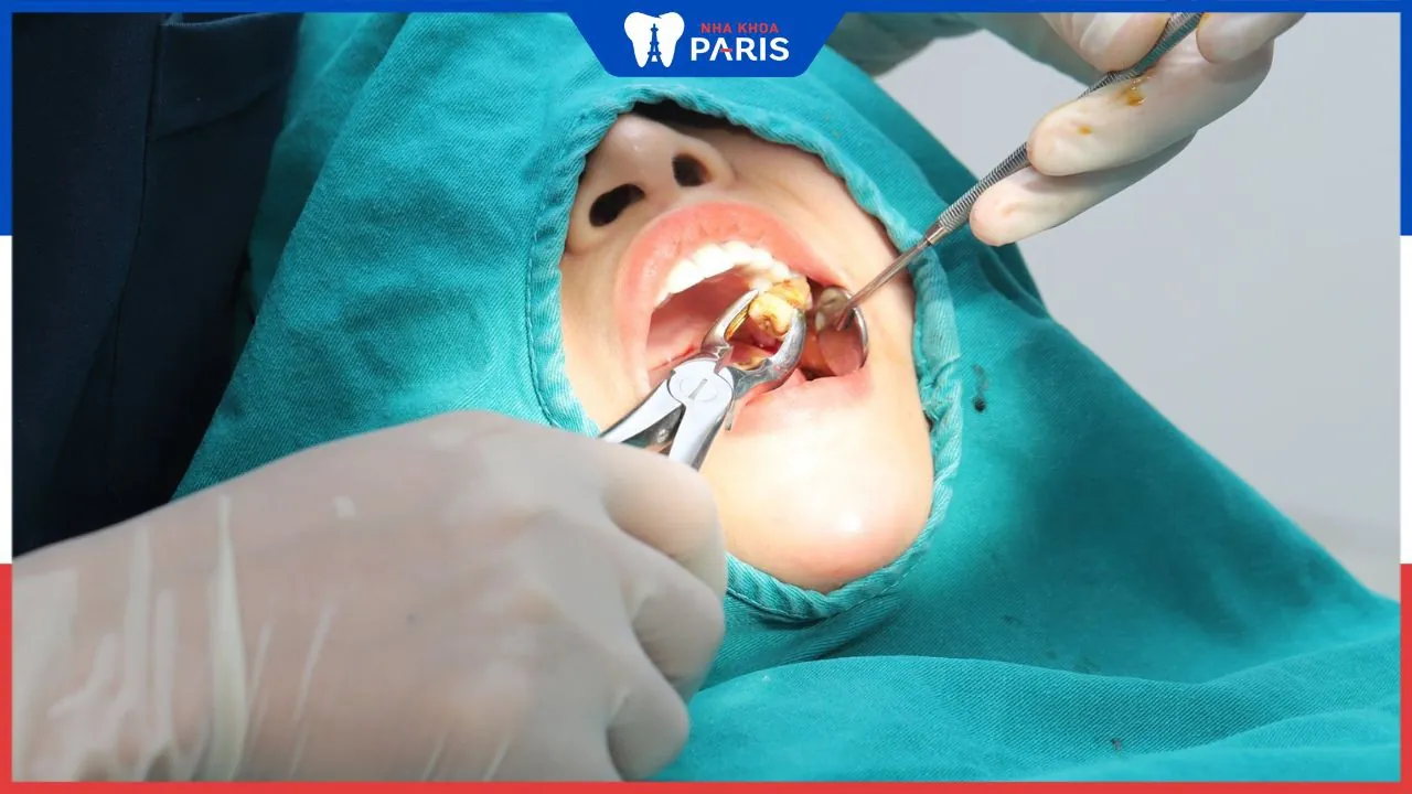 Hình ảnh sau khi nhổ răng khôn , Cách chăm sóc sau nhổ răng