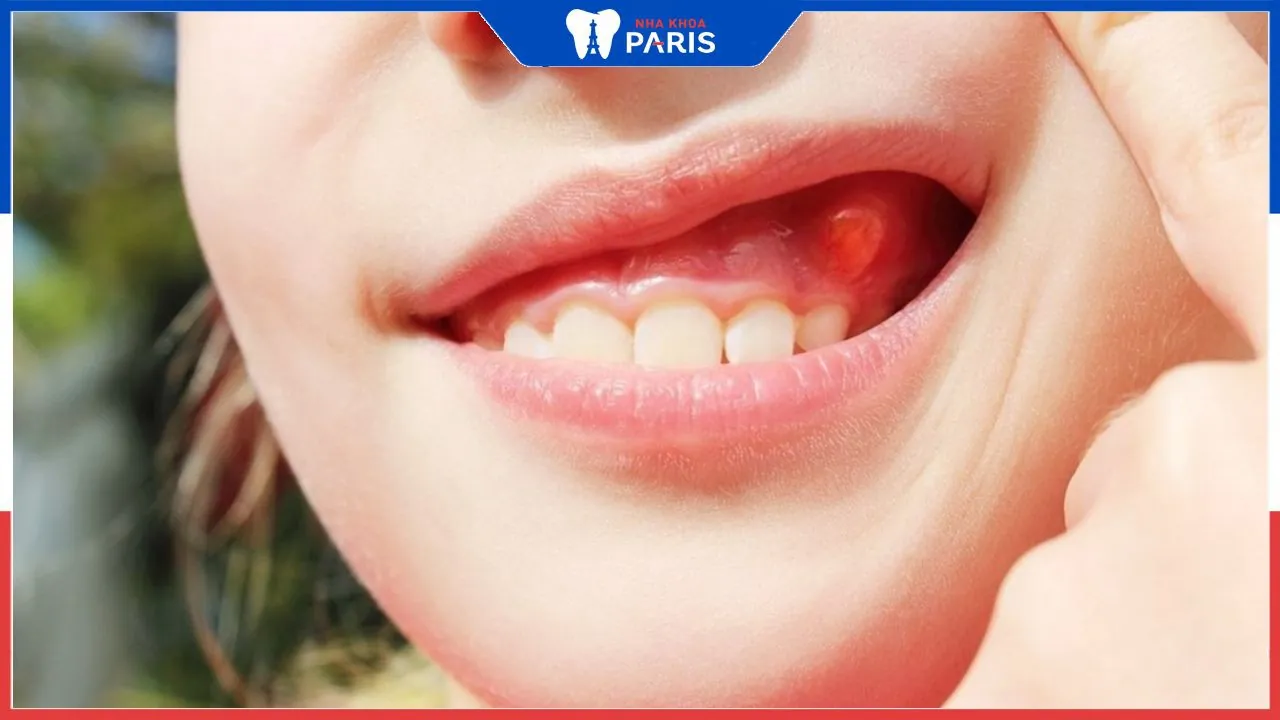Nổi cục cứng ở lợi: Các nguyên nhân và phương pháp điều trị