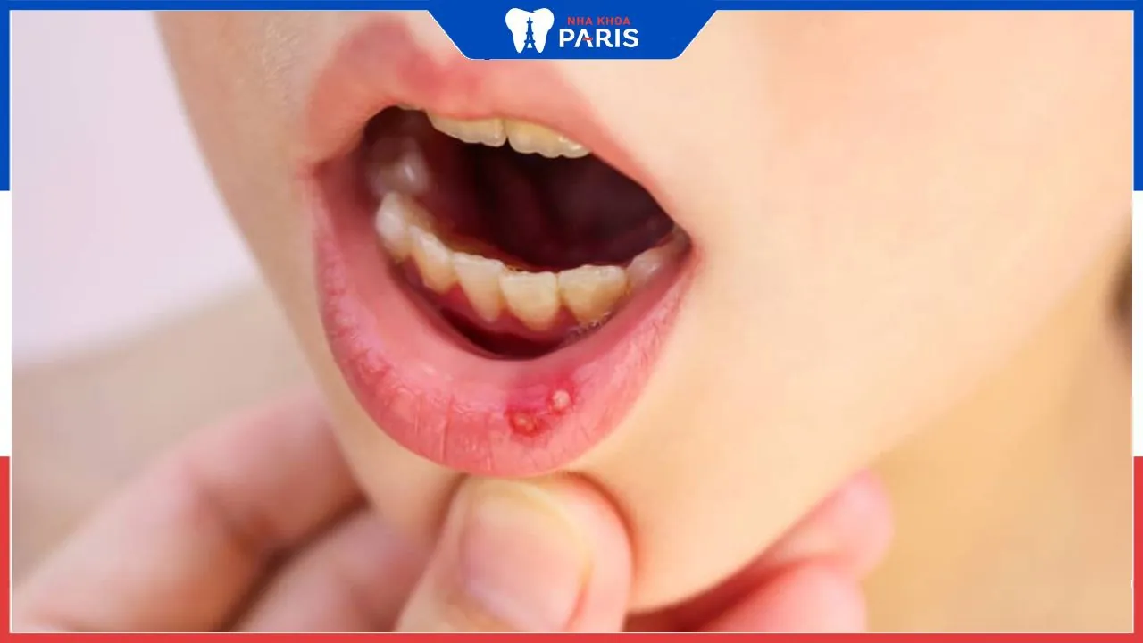 Hình ảnh nhiệt miệng ở trẻ em, nhận biết và cách điều trị