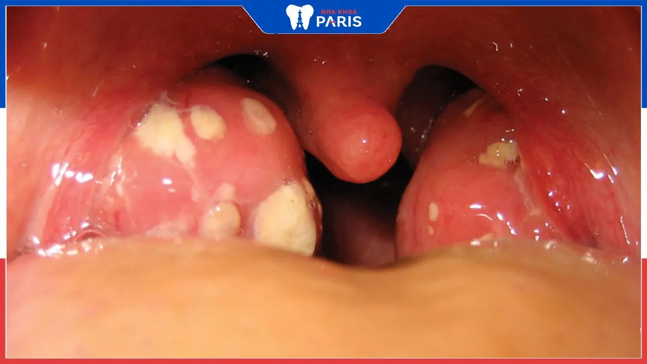 Viêm amidan hốc mủ: Dấu hiệu, biến chứng và cách điều trị