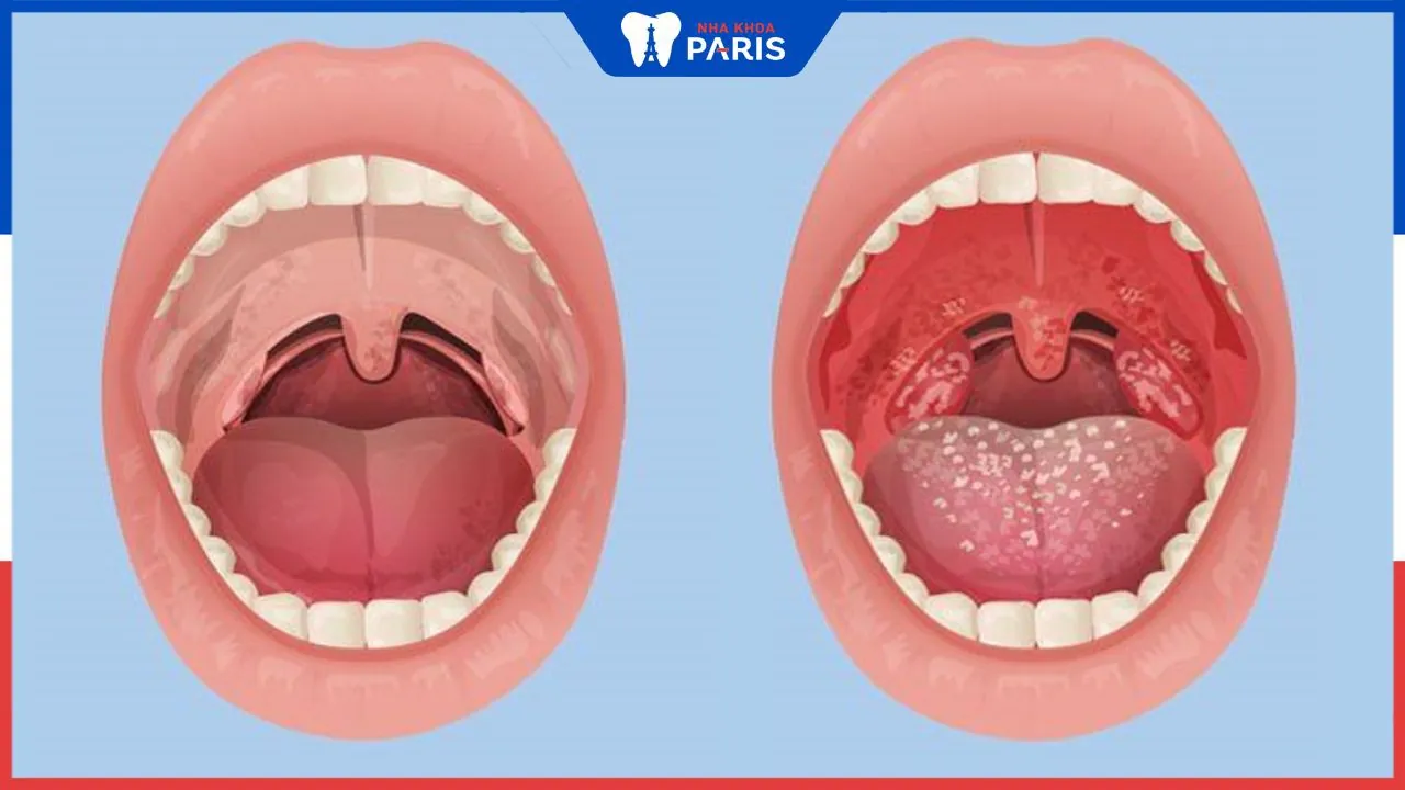 Viêm họng mãn tính: Nguyên nhân, triệu chứng và cách điều trị