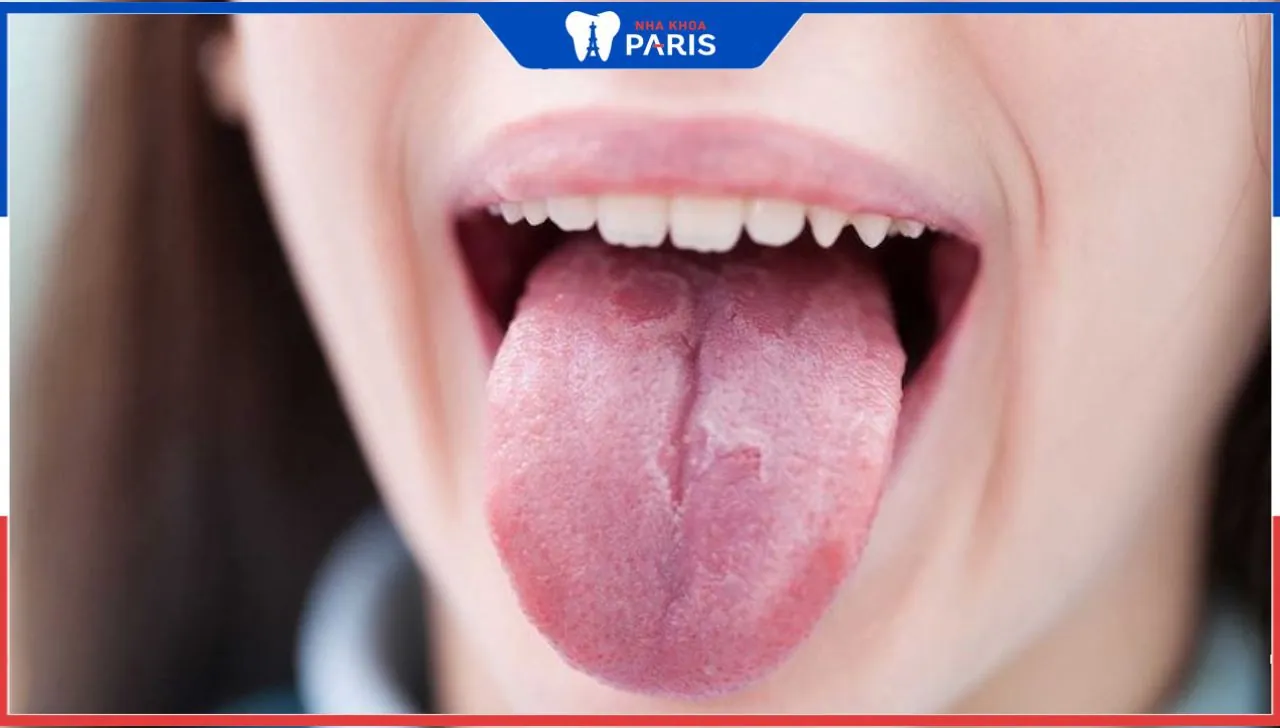 Cảnh Báo Về Các Bệnh Lưỡi: Tìm Hiểu Và Phòng Ngừa