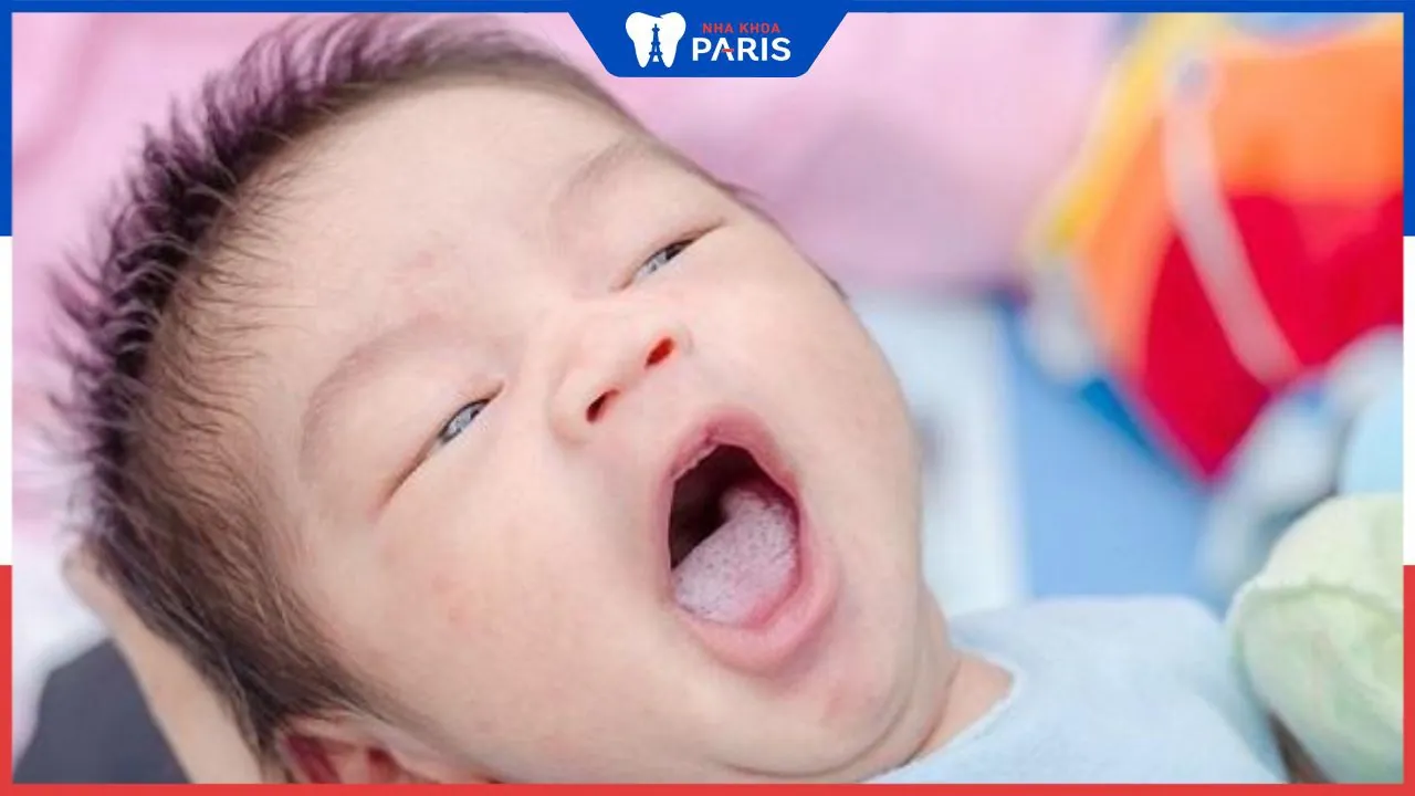 Hình ảnh trẻ bị tưa lưỡi, nguyên nhân và cách điều trị