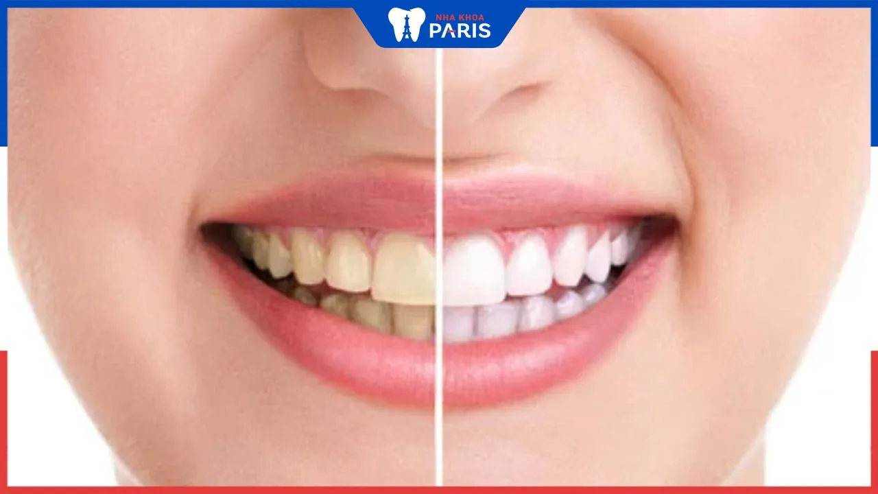 Nhận biết răng bị lão hóa sớm, khắc phục sớm