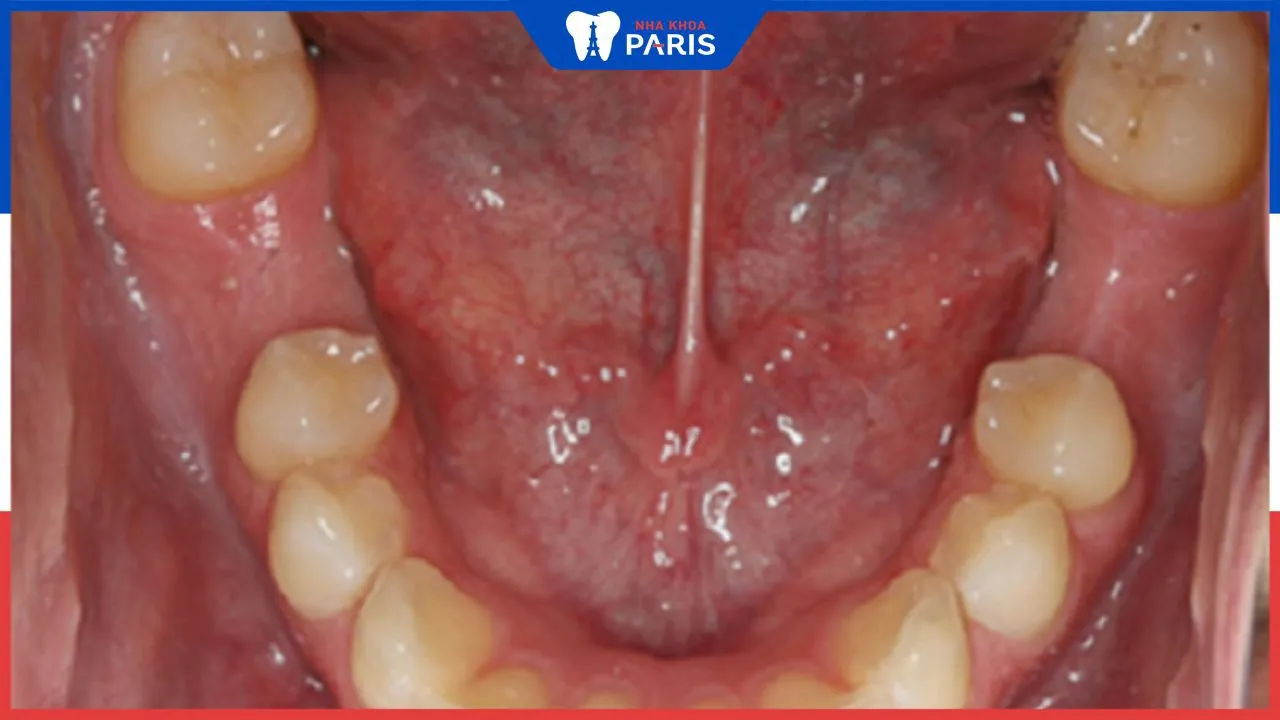 Răng cấm có thay không? Những vấn đề thường gặp về răng cấm