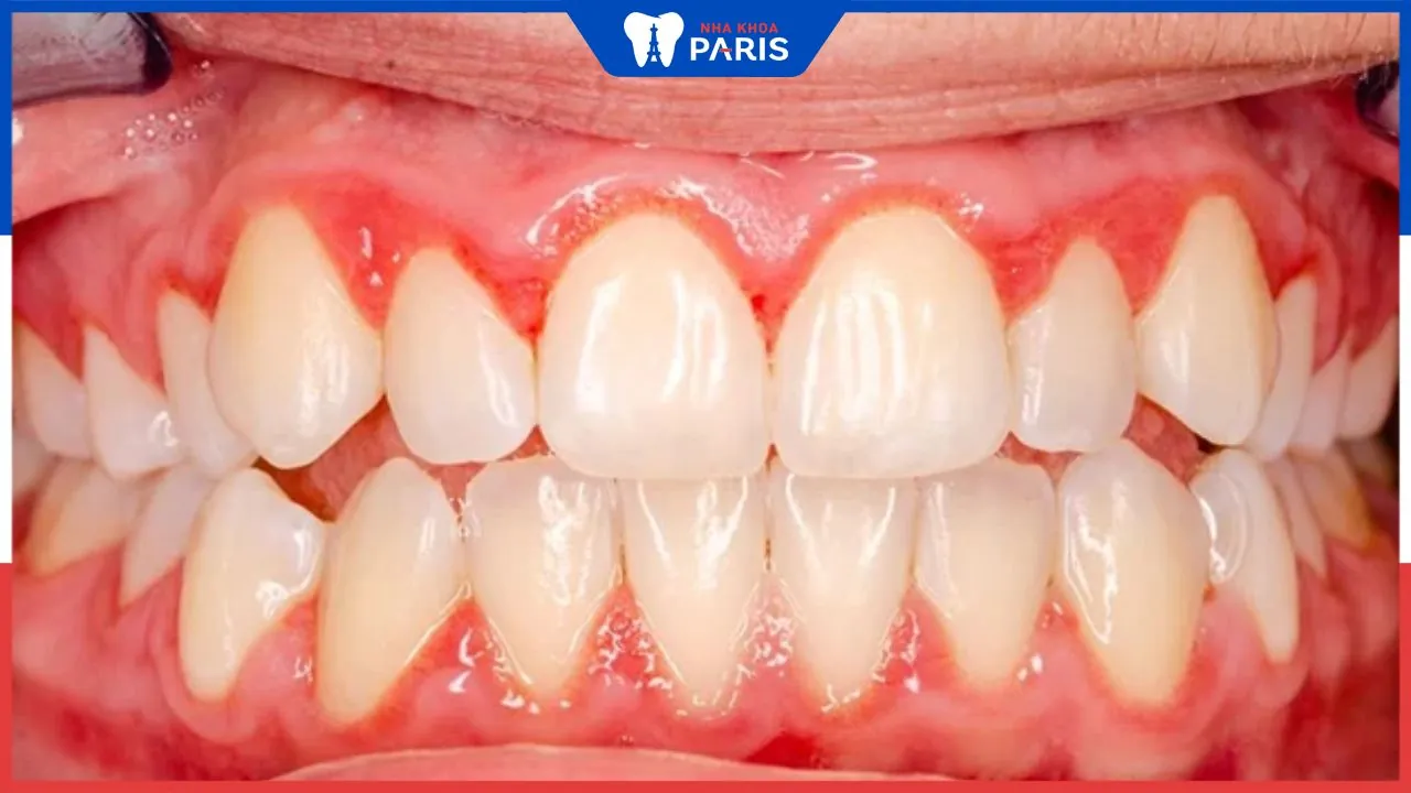 Viêm chân răng giả nguyên nhân do đâu? Cách điều trị thế nào