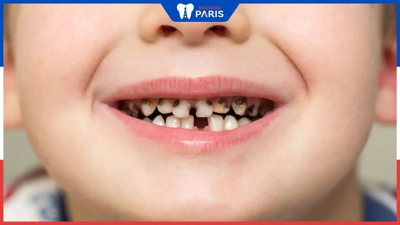 Top 12 thuốc xịt chống sâu răng cho bé được ưa chuộng