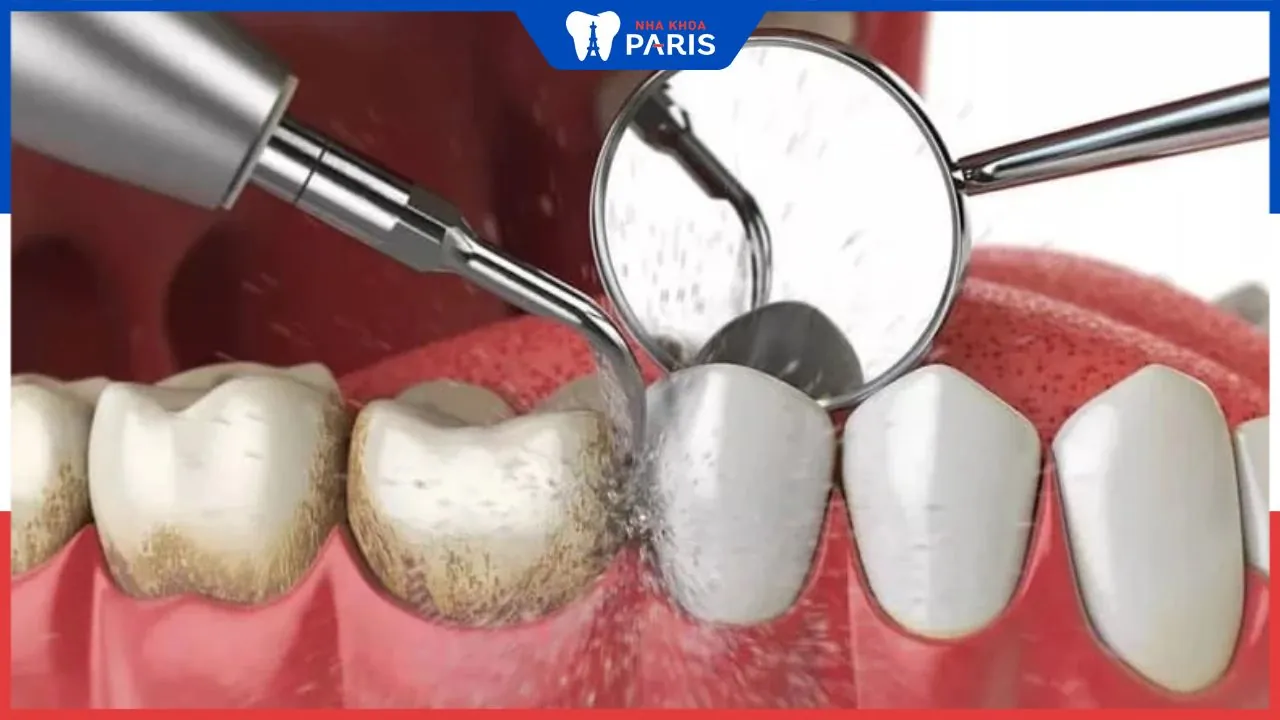 Bị viêm lợi có nên lấy cao răng? Có gây biến chứng nguy hiểm không