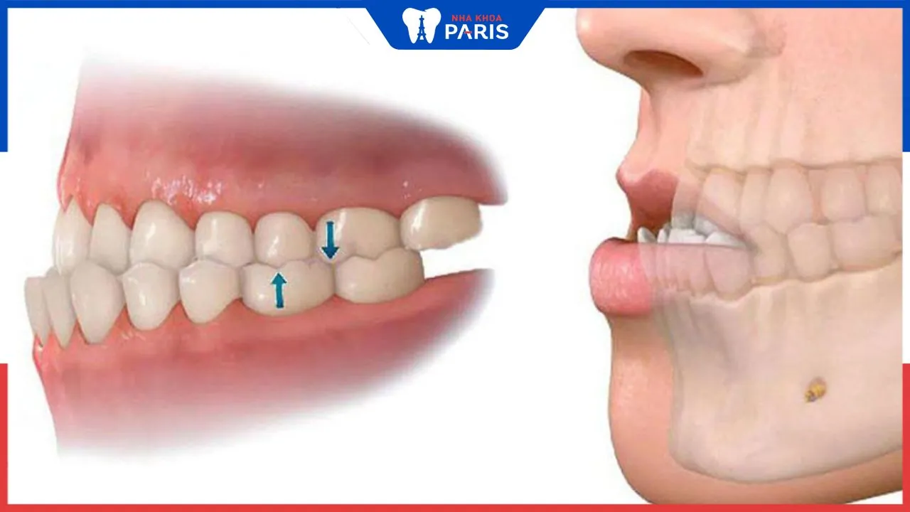 Bọc răng sứ cho răng móm có cho hiệu quả thực sự