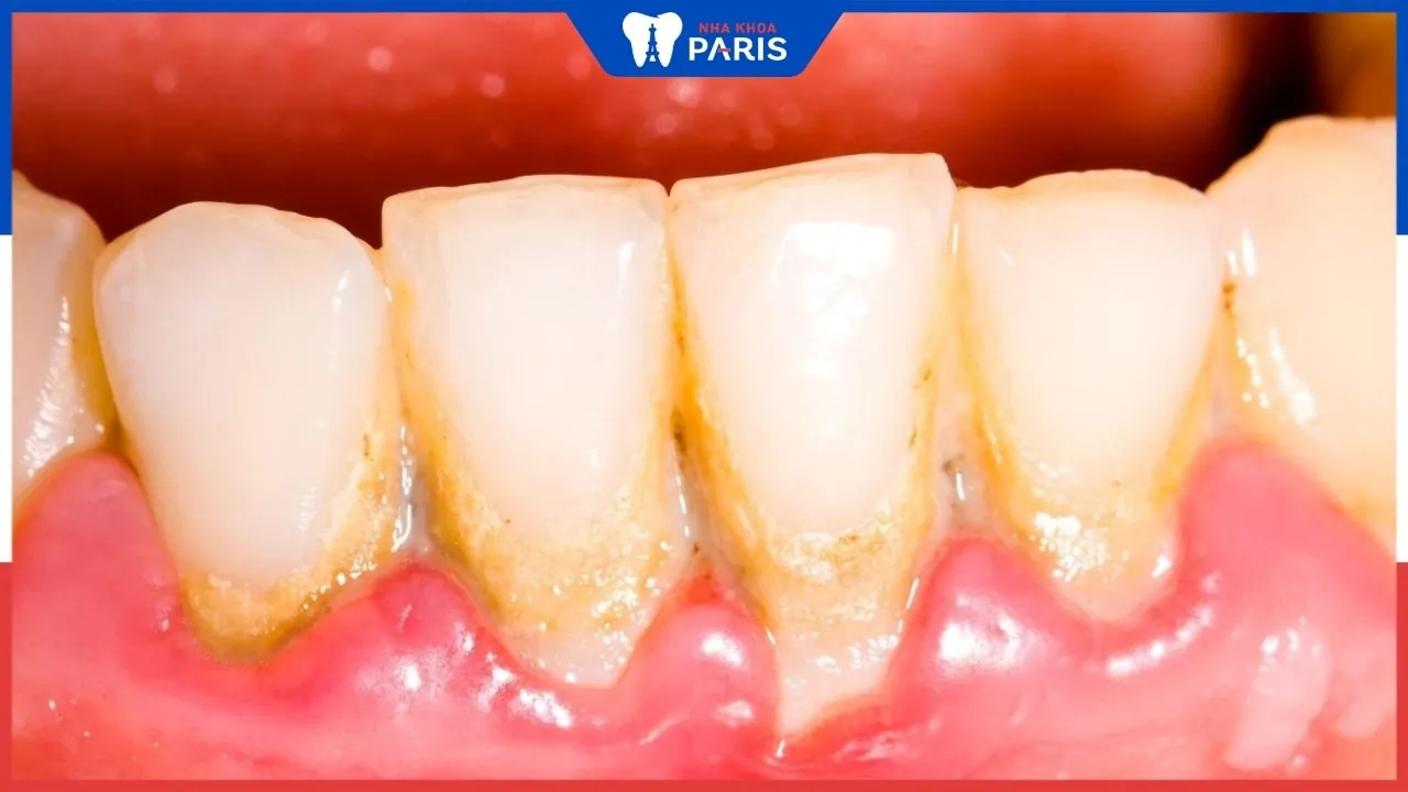 Hỏi đáp: Cao răng nhiều có gây hôi miệng không