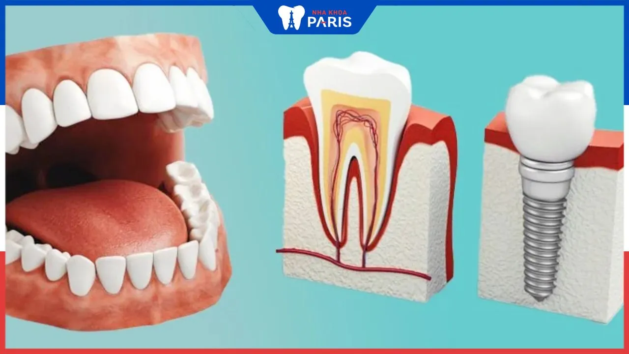 Tìm hiểu về trụ Implant SIC: Cấu tạo, ưu điểm và chi phí