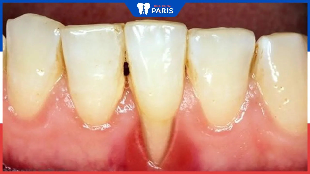 Nguyên nhân nào dẫn tới lợi không bám vào chân răng