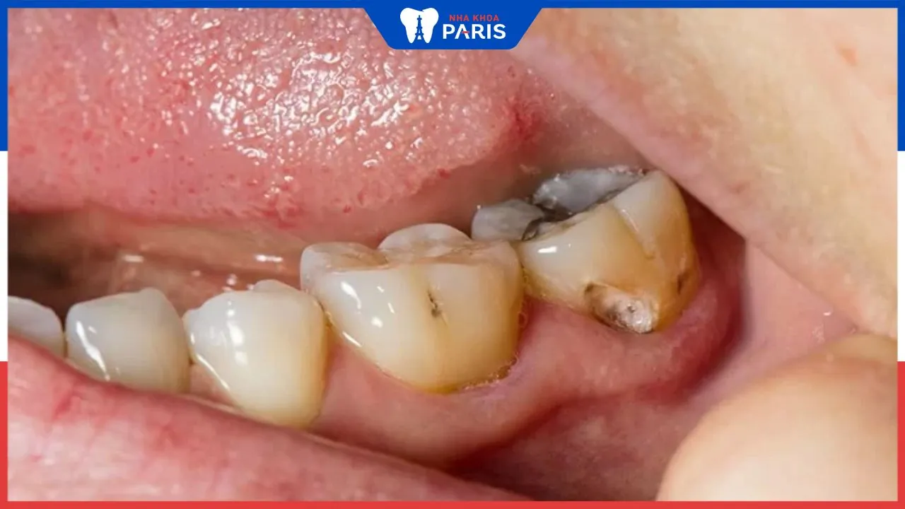 Nên làm gì khi răng bị sâu? Cách trị dứt điểm sâu răng