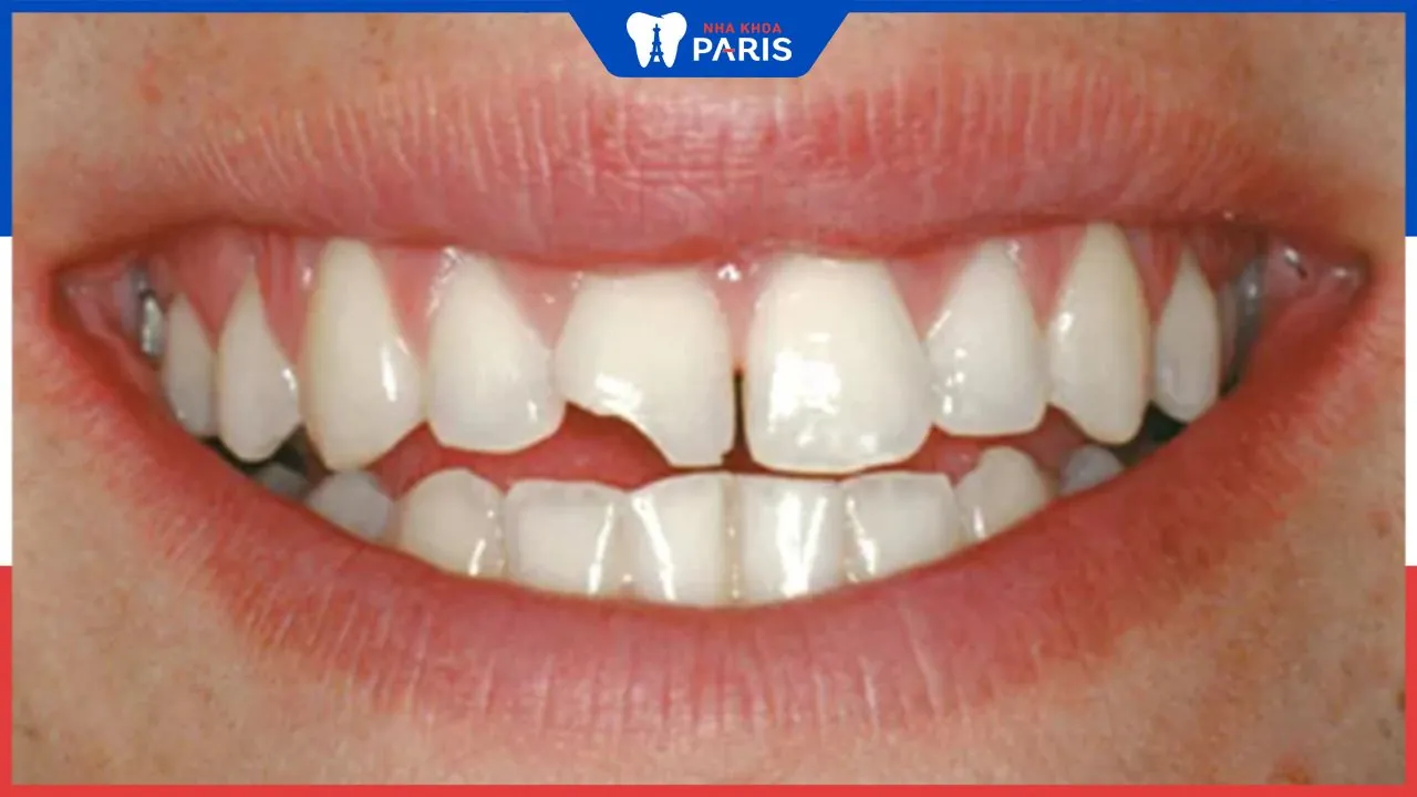 Răng bị bể lớn có bọc sứ được không?Bác sĩ nha khoa giải đáp