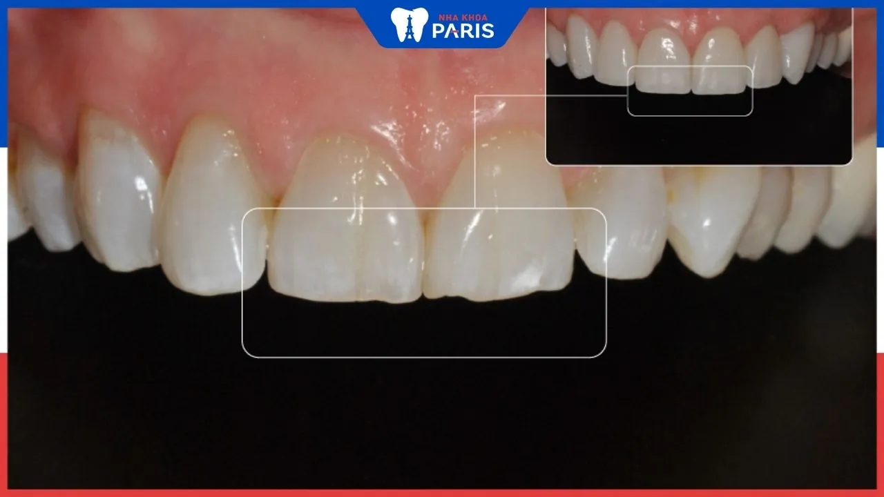 Hỏi đáp: Răng sứ có bị mòn theo thời gian không