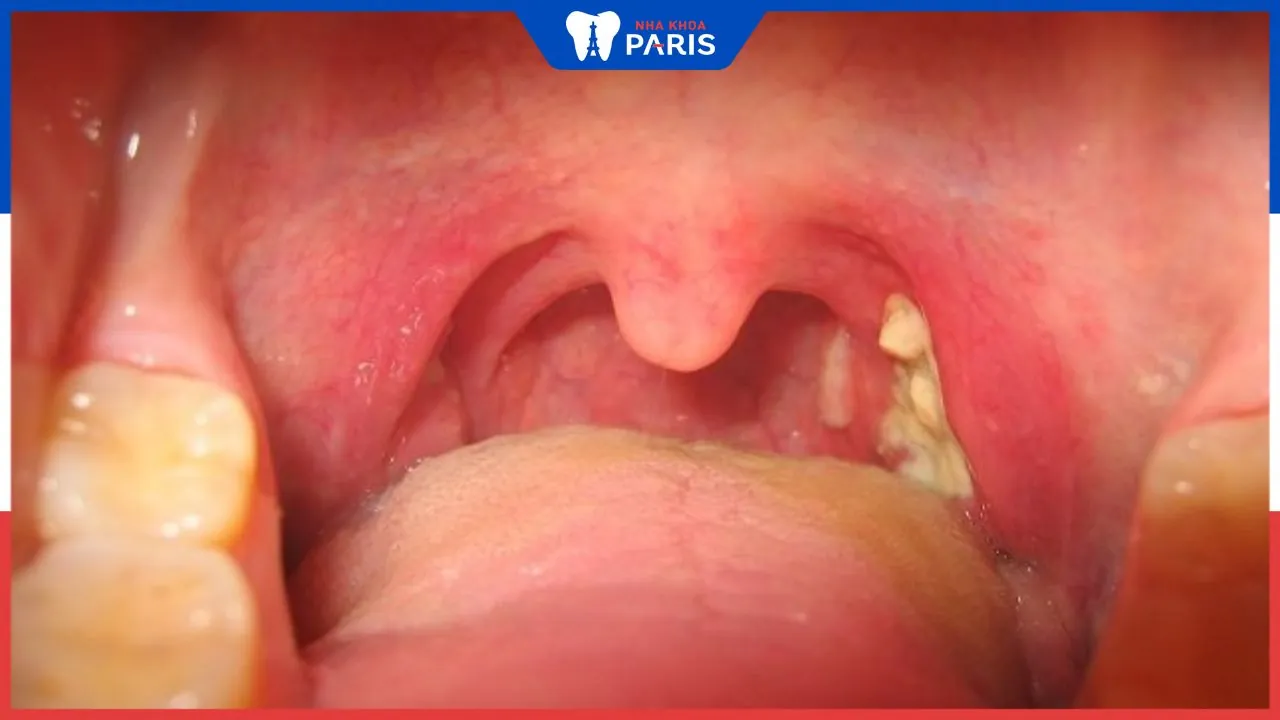 Viêm họng cấp có lây không? Những con đường lây nhiễm