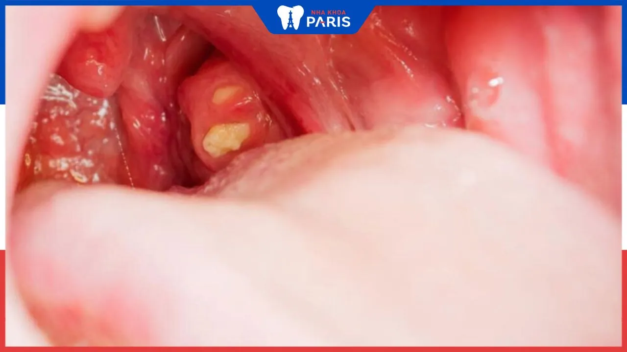 Viêm họng có hạt trắng nguyên nhân do đâu