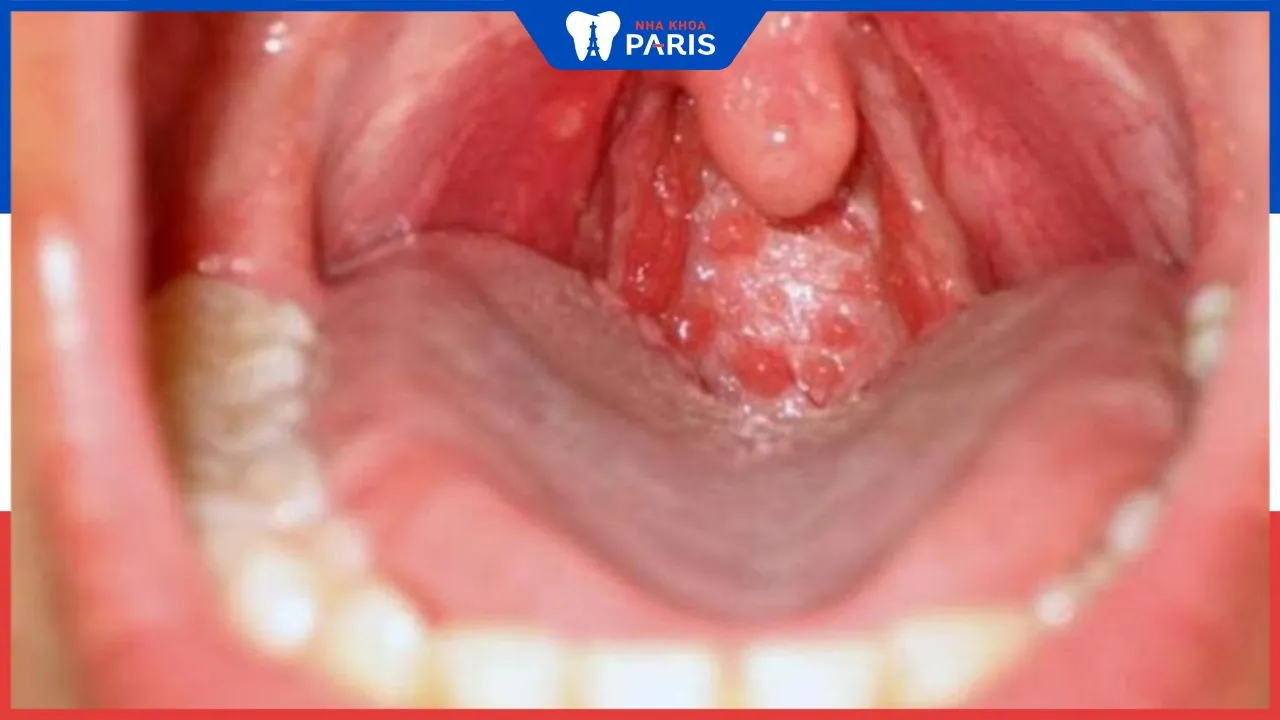 Viêm họng hạt có lây không? Con đường nào lây bệnh