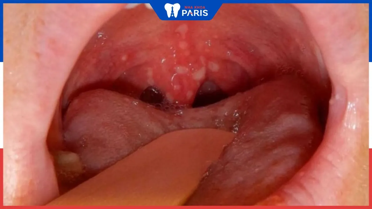 Viêm họng hạt có mủ: Dấu hiệu nhận biết và cách điều trị
