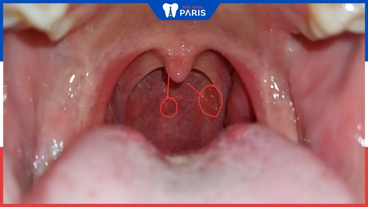 Viêm họng hạt có tự khỏi không – Cách chữa tại nhà