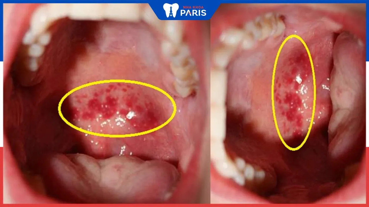 Giải đáp: Viêm họng mãn tính có nguy hiểm không