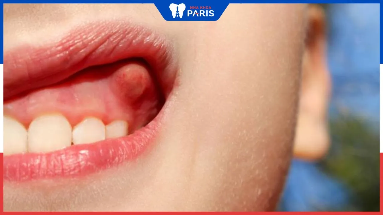 Viêm lợi mọc hạch – Nguyên nhân, dấu hiệu và cách điều trị