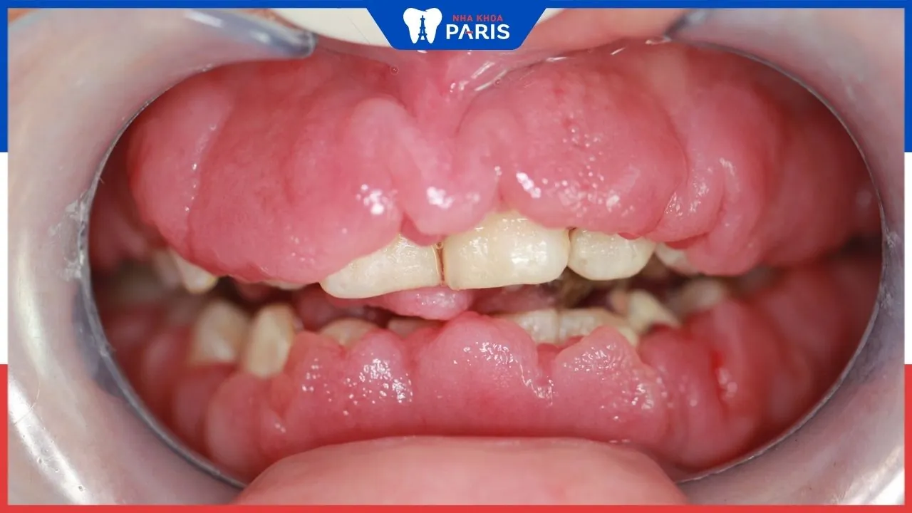 Viêm lợi phì đại: Nguyên nhân, dấu hiệu và cách điều trị