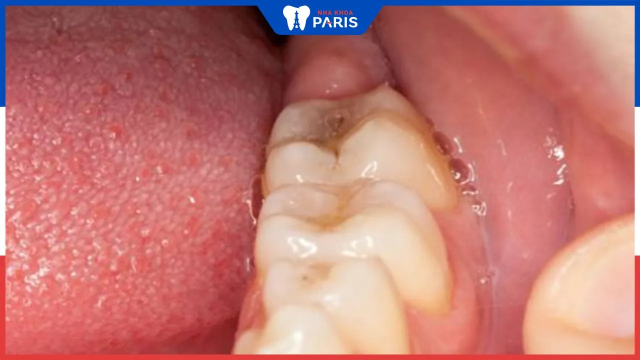 Viêm lợi trùm có mủ: Dấu hiệu, nguyên nhân và cách khắc phục