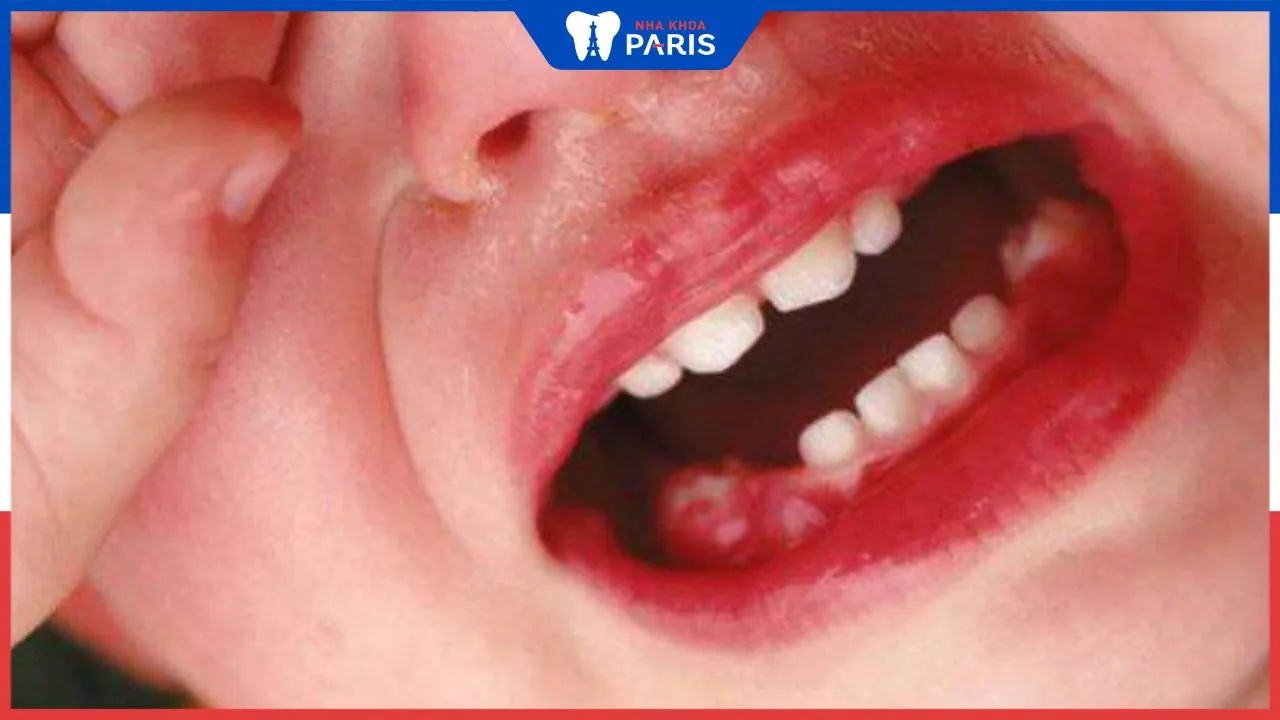 Viêm lợi trùm ở trẻ em: Dấu hiệu và biện pháp điều trị an toàn