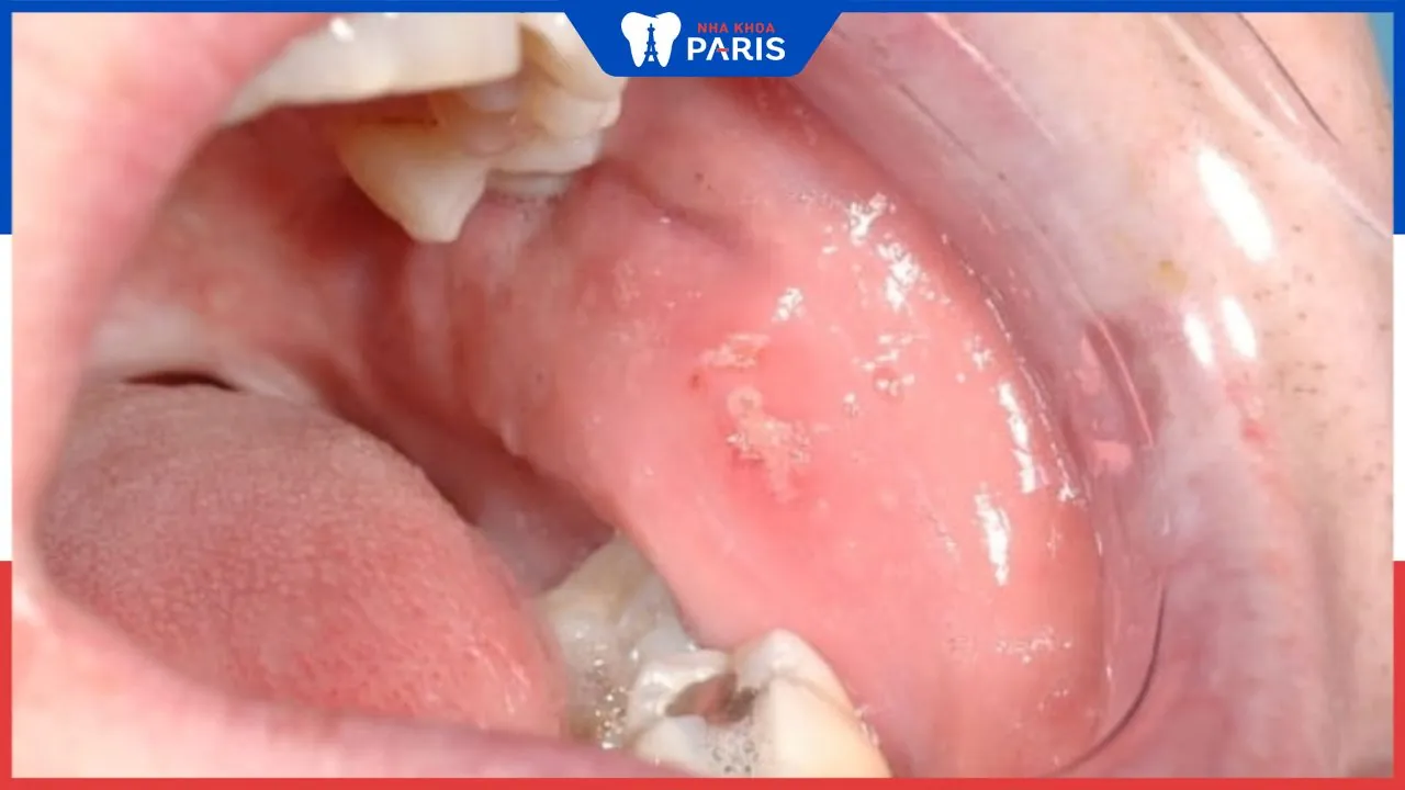 Bệnh viêm niêm mạc má: Nguyên nhân và phương pháp điều trị