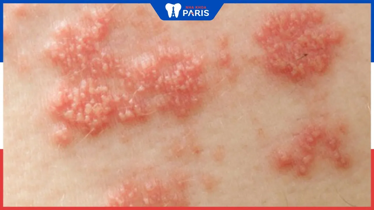 Bệnh Lupus ban đỏ có nhổ răng được không, những rủi do bạn cần biết