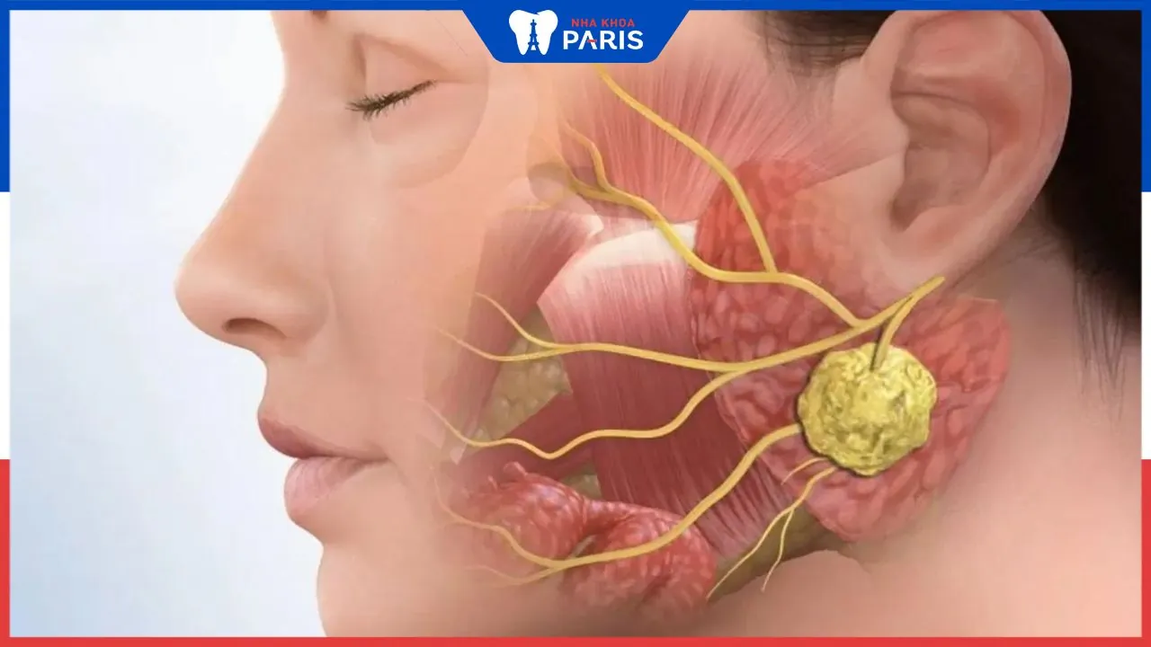 Chi phí điều trị viêm khớp thái dương hàm từ A-Z