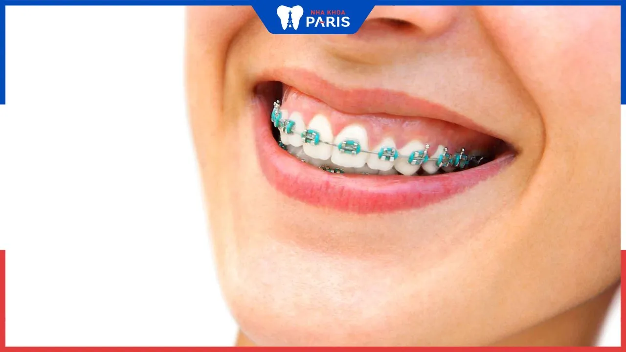 Đang niềng răng có cắt lợi được không? Thời điểm phù hợp