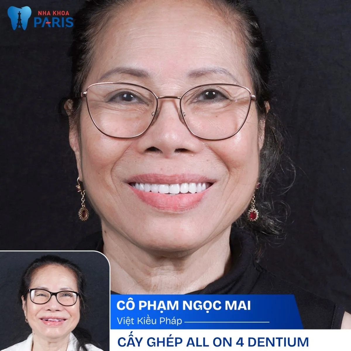 Địa chỉ trồng răng uy tín dành riêng cho Kiều Bào nước ngoài