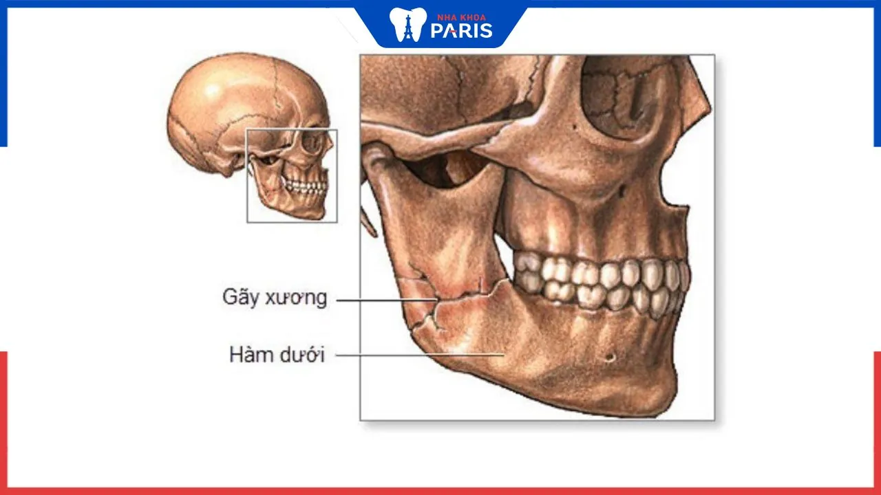 Giải đáp: Gãy xương quai hàm bao lâu thì lành