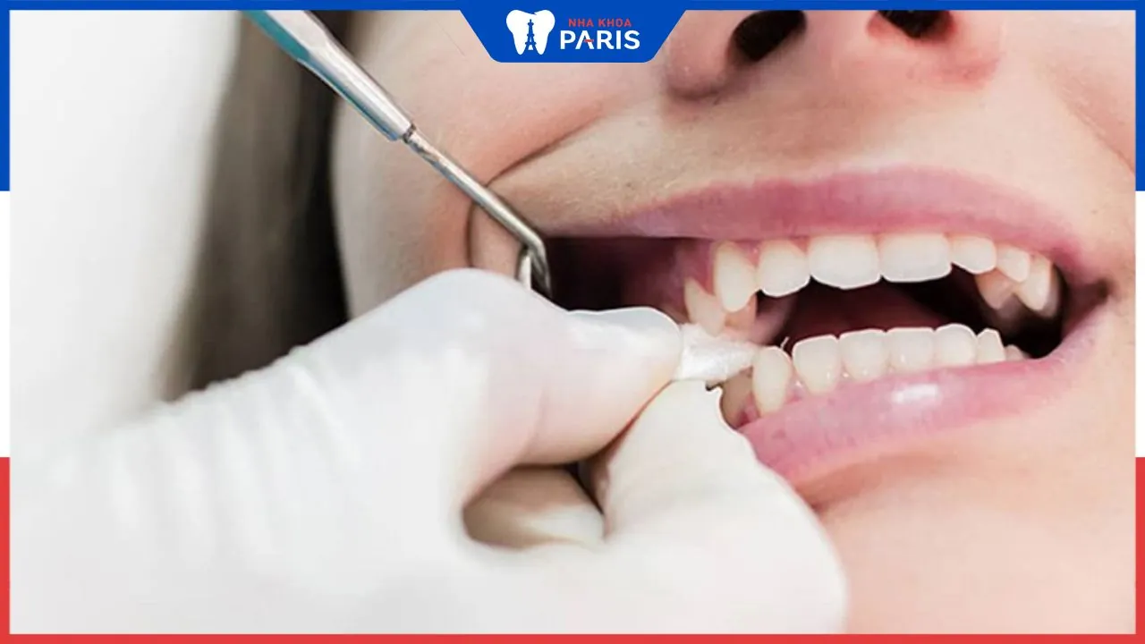 Khoảng cách giữa 2 lần nhổ răng khôn tối thiểu là bao lâu