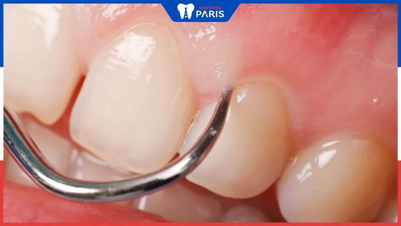 Nạo túi nha chu: Lợi ích, quy trình và những lưu ý quan trọng