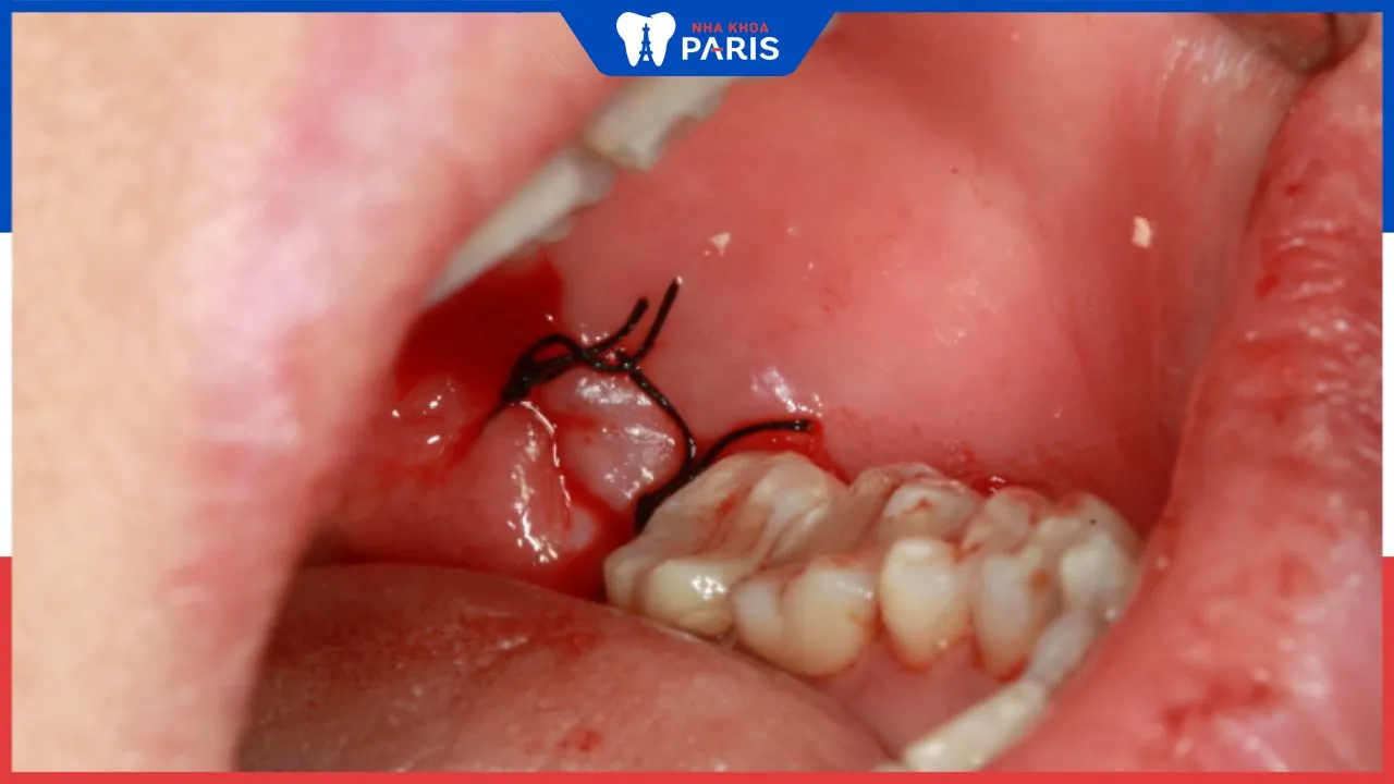Nhổ răng khôn có cần khâu không? lưu ý để viết thương nhanh lành