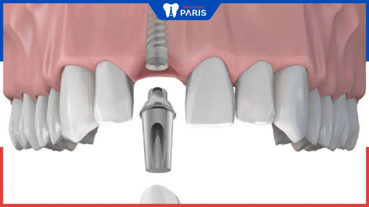 Trồng răng cửa có đau không? Phương pháp trồng răng an toàn