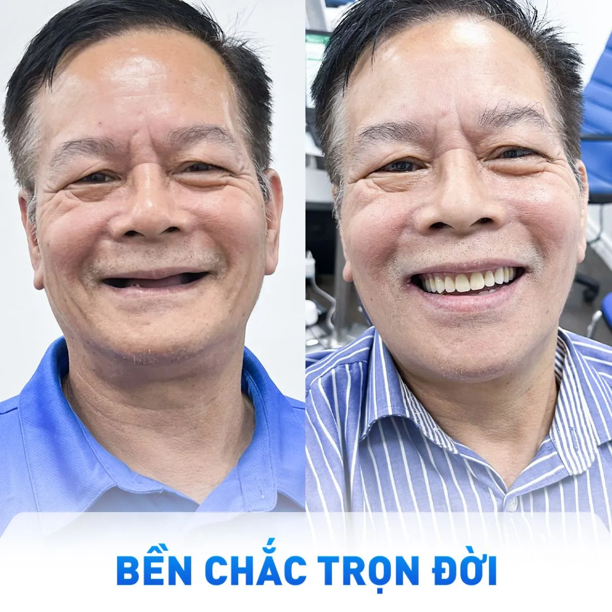 Trồng răng Implant tại Nha khoa Paris điểm đến của Việt kiều khi về nước
