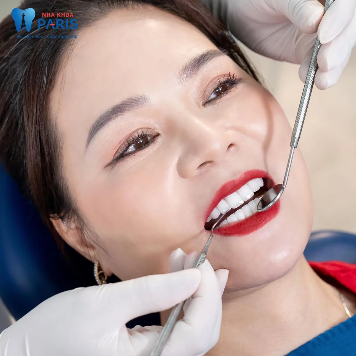 Về nước làm răng – Không lăn tăn về giá