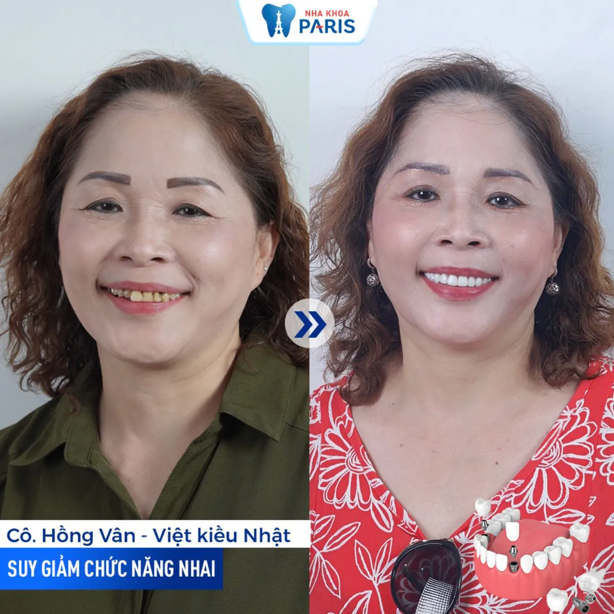 Địa chỉ Nha khoa hàng đầu được nhiều Việt kiều lựa chọn làm răng tại TPHCM